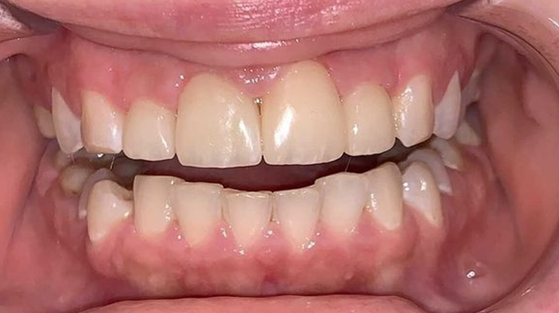 Исправление эстетики центральных зубов